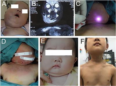 Comprehensive Therapy for Infant Vascular Tumor Associated With Kasabach–Merritt Phenomenon—Single-Center Primary Experience